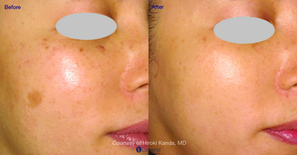 Photorejuvenation_7