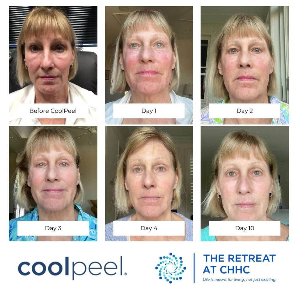 CoolPeel Progression