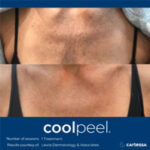 Before and after cool peel treatment on the chest.