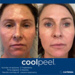 Before and after images of facial cool peel treatment.