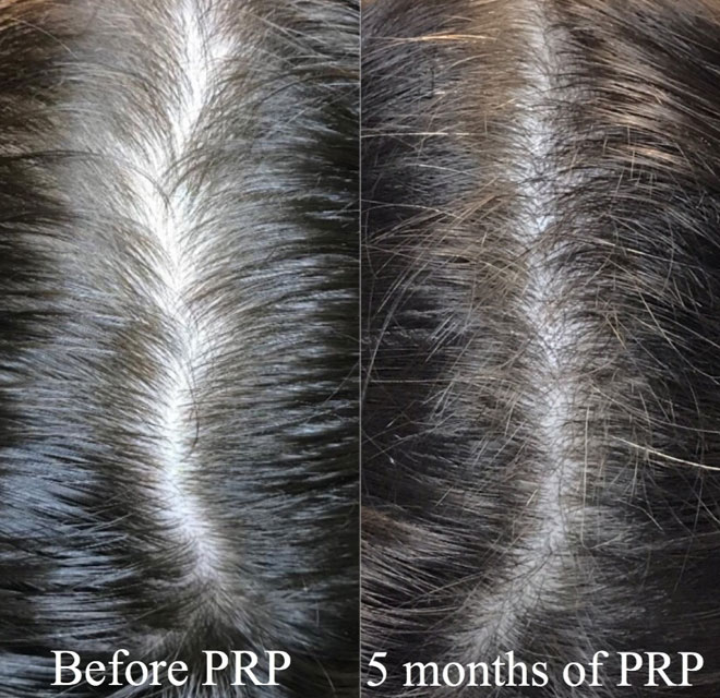 Before and after image of PRP hair restoration treatment.