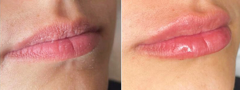 Before and after front view of dermal filler services in Columbia, SC.