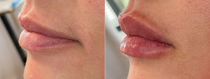 Before and after side view of dermal filler services in Columbia, SC.