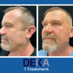 DEKA Laser Face Before & After